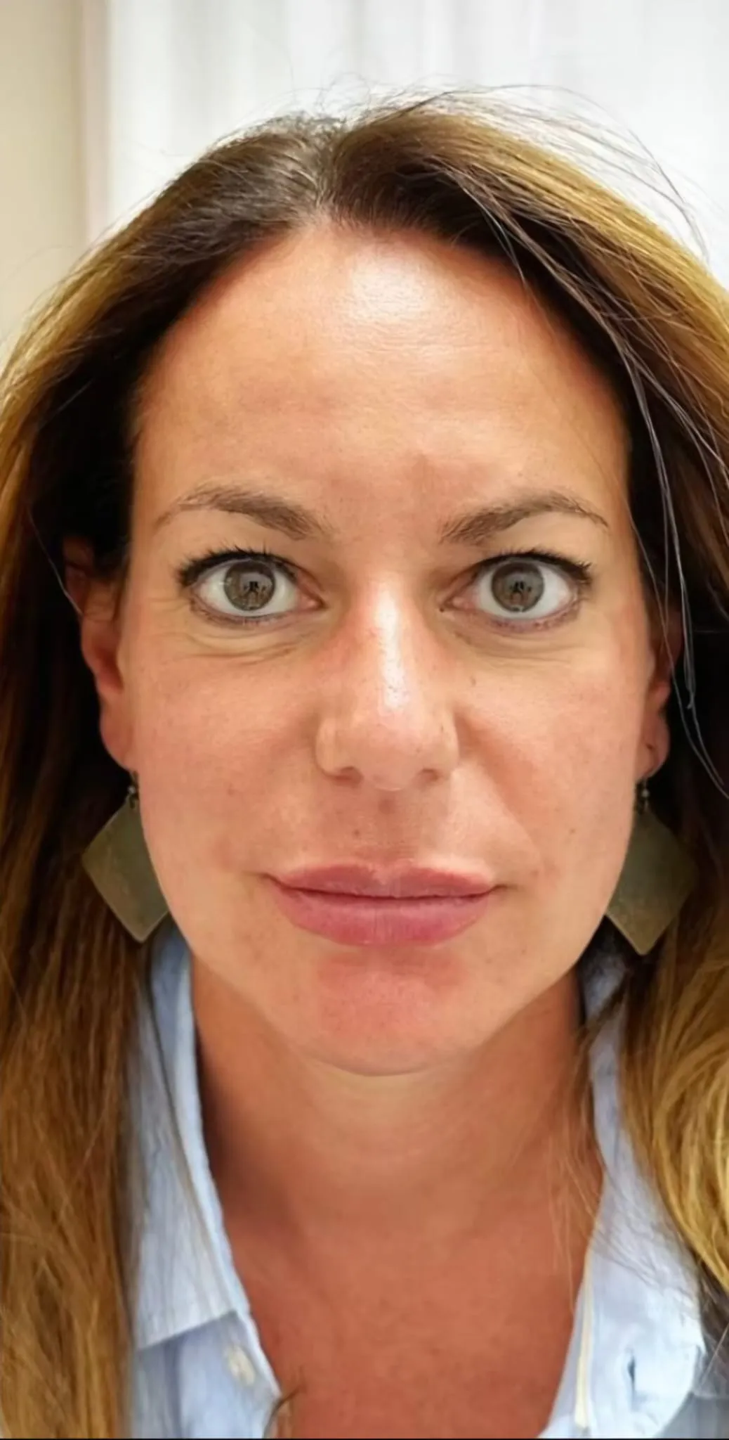 Dopo trattamento botox caso 1