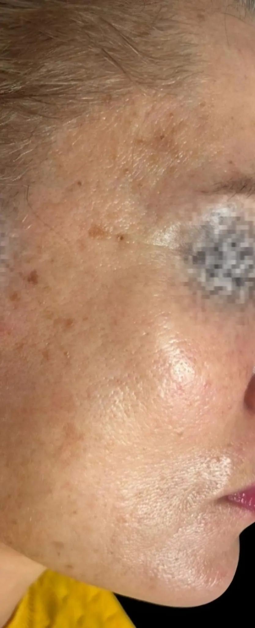 Dopo trattamento botox caso 2