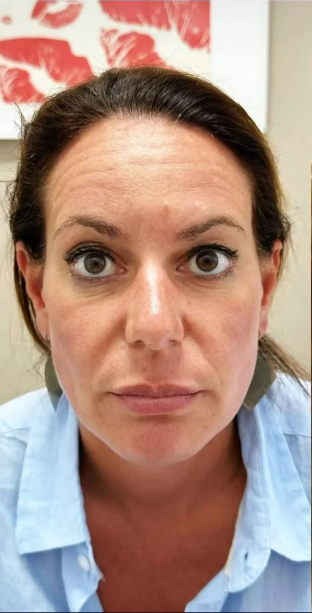 Prima trattamento botox caso 1