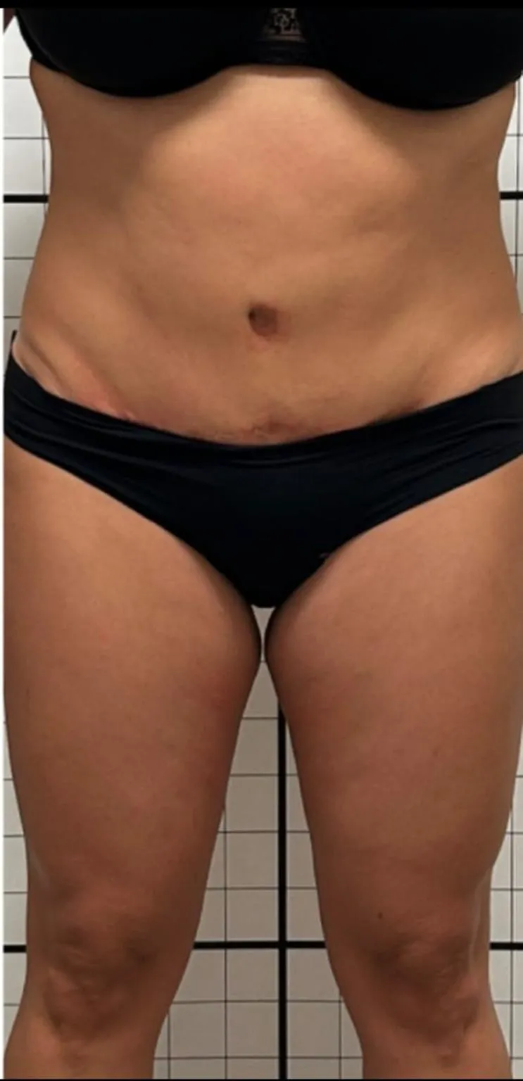 Dopo trattamento corpo