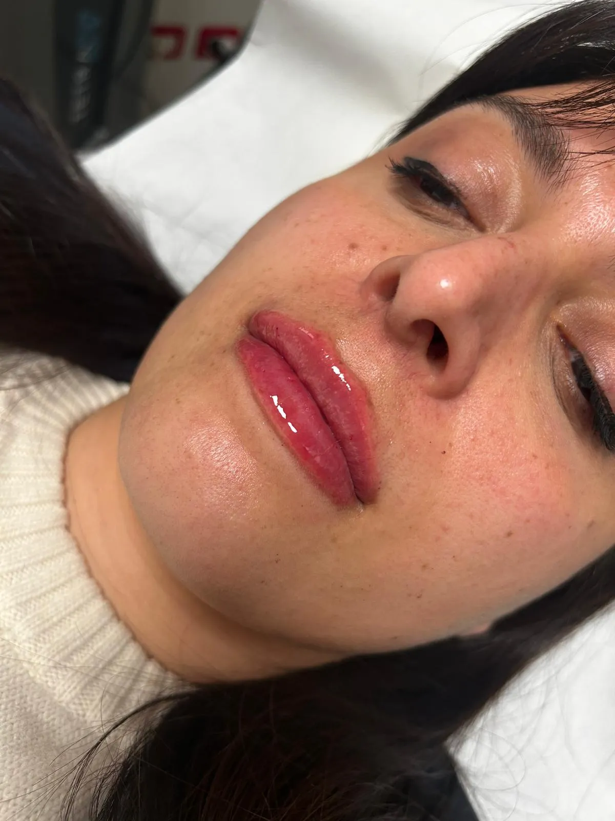 Dopo trattamento filler caso 2