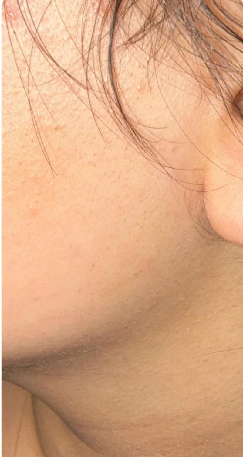 Dopo epilazione laser