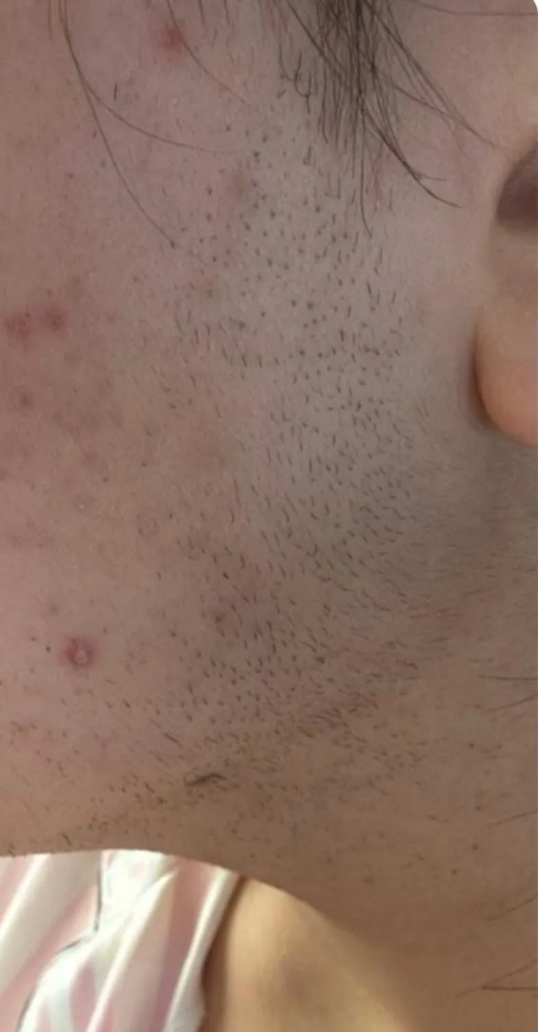 Prima epilazione laser