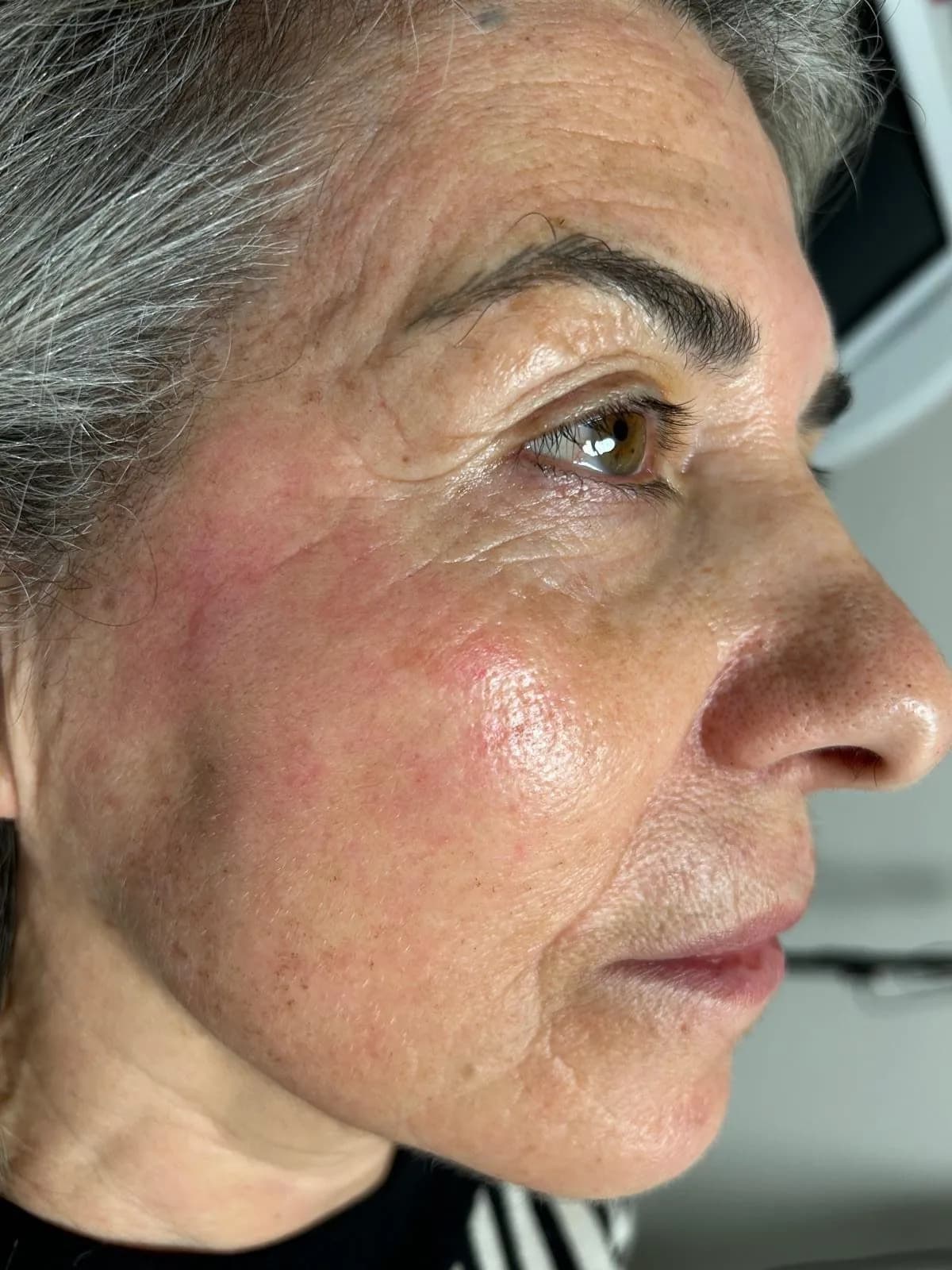 Dopo trattamento macchie caso 1