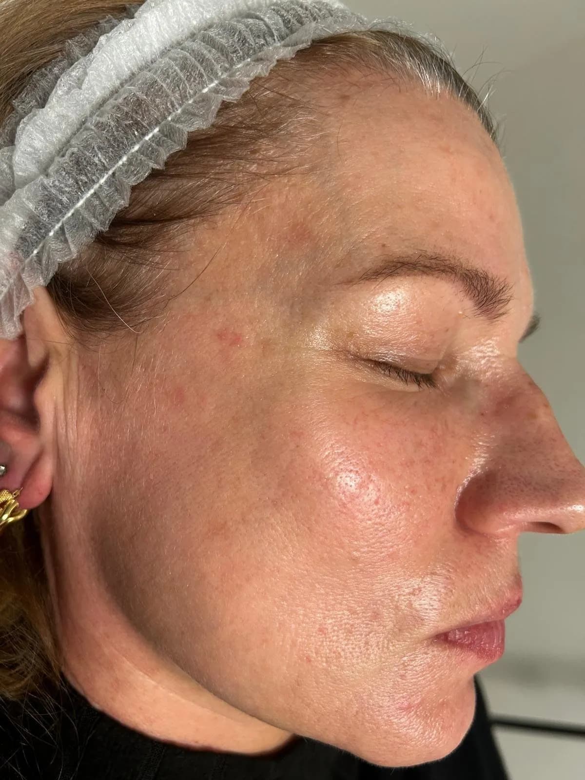 Dopo trattamento macchie caso 2