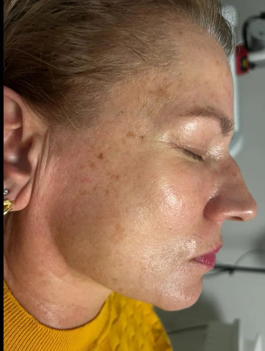 Prima trattamento macchie caso 2