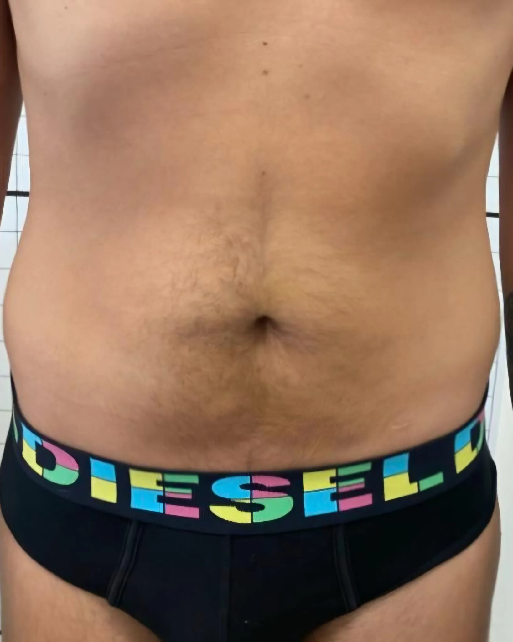 Dopo trattamento smagliature o cicatrici caso 1