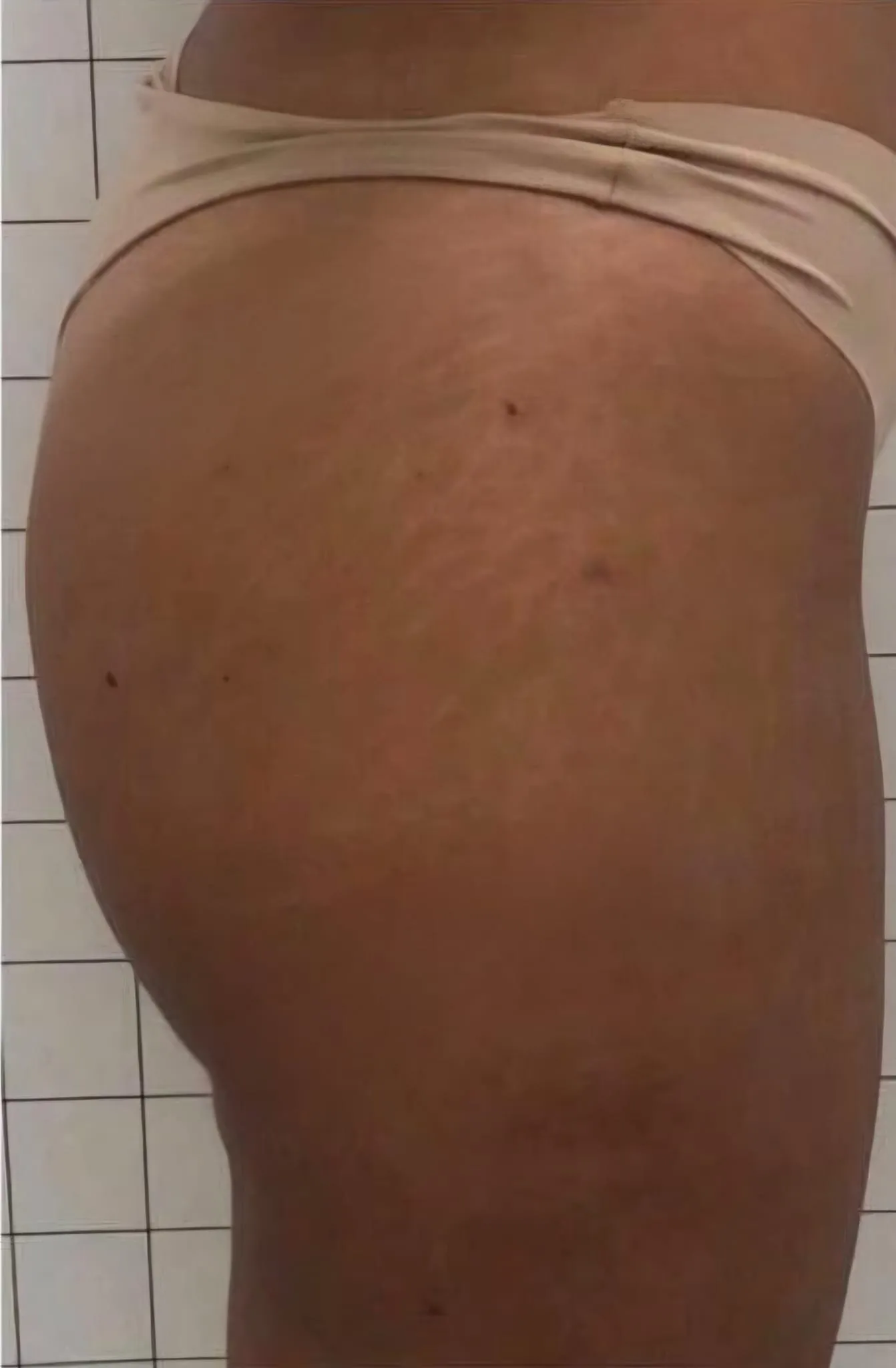 Dopo trattamento smagliature o cicatrici caso 2