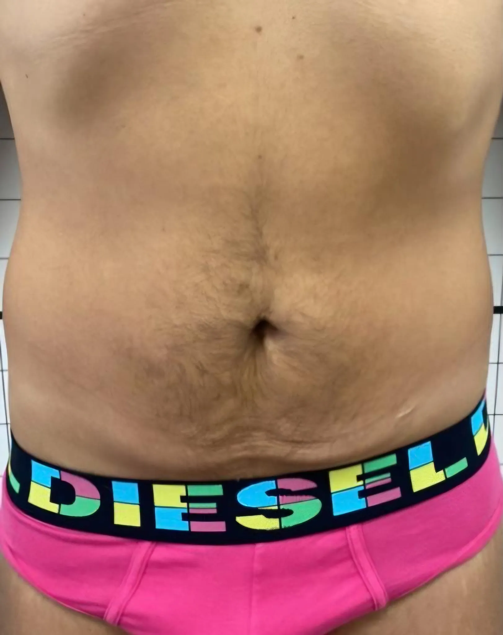 Prima trattamento smagliature o cicatrici caso 1