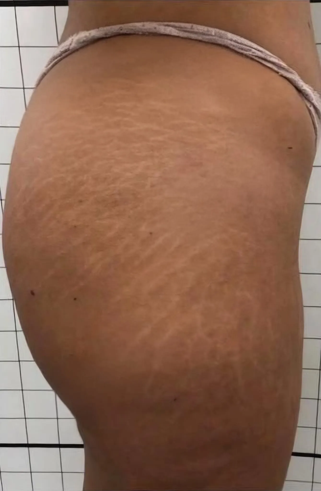 Prima trattamento smagliature o cicatrici caso 2