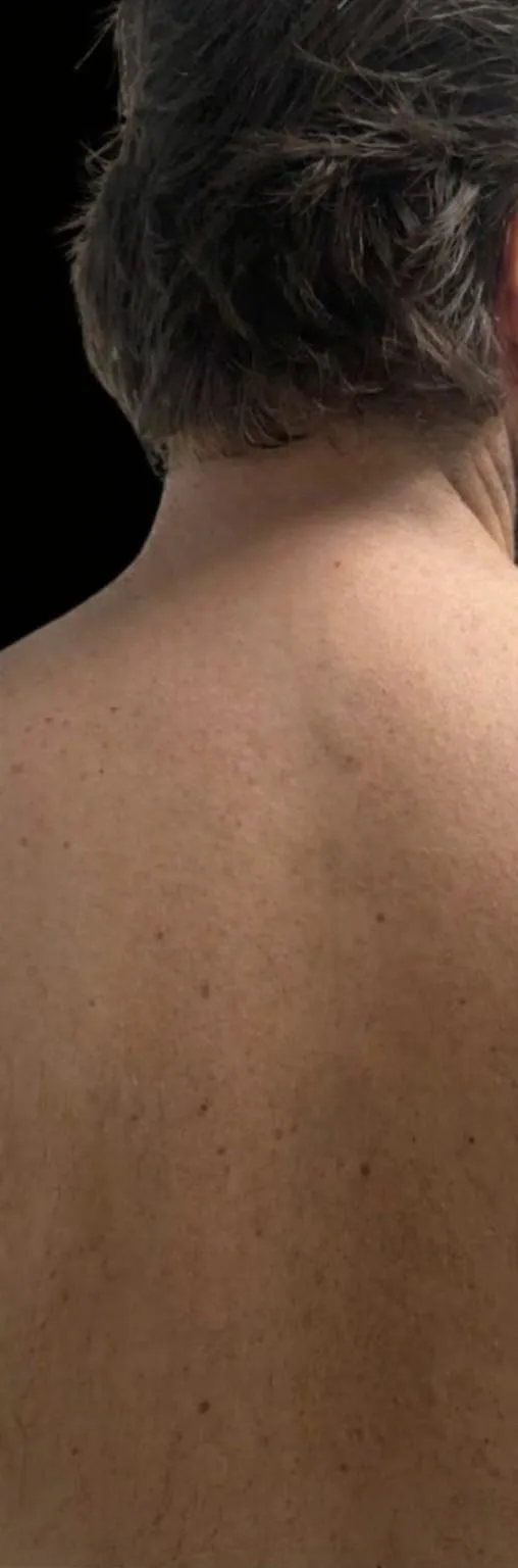 Dopo rimozione tatuaggio