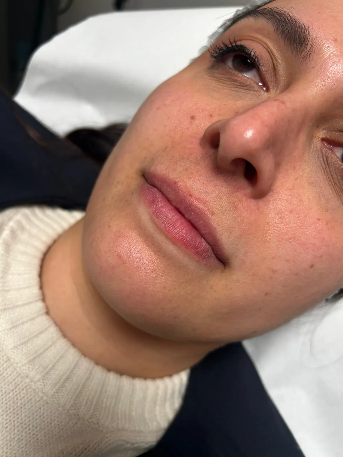 Prima trattamento filler caso 2